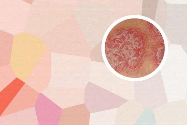 长春什么医院治银屑病正规-长春治疗银屑病到哪家比较好