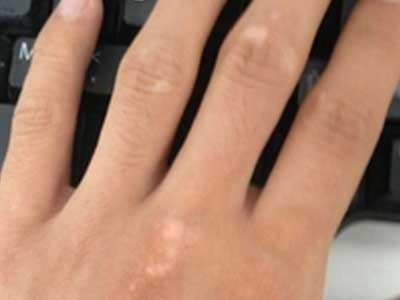 长春哪里能看好白癜风-长春正规白癜风医院