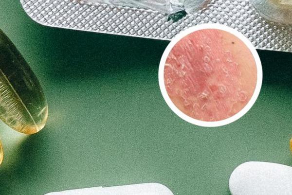 长春银屑病需要治疗吗-长春专业银屑病医院哪个好