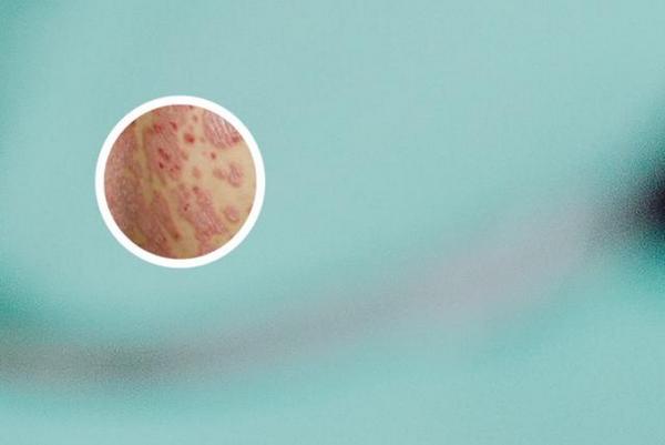 长春白癜风医院真的有正规吗-长春哪家医院治疗白癜风效果好