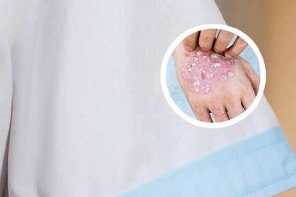 长春哪个医院治疗银屑病效果好-长春哪个医院专业治疗银屑病