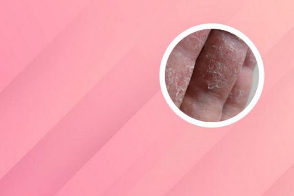 长春哪家医院专治银屑病-长春银屑病医院在哪里