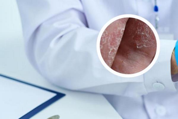 长春专业银屑病医院哪家好-长春银屑病医院治疗银屑病多少钱